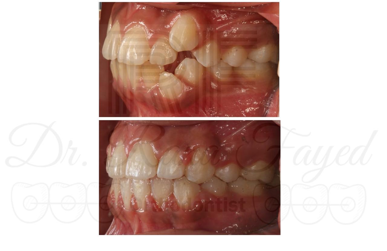 صور قبل وبعد لحالة تقويم الأسنان ORTHO-01
